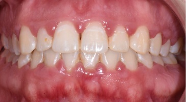 periodontal decontamination